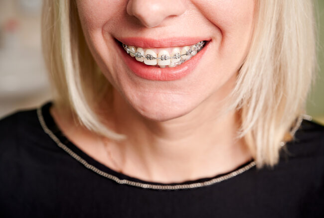 Close Up Of Smiling Patient Showing White Straight Teeth With Or