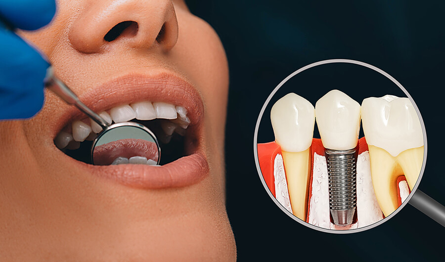 dental implants in nw calgary