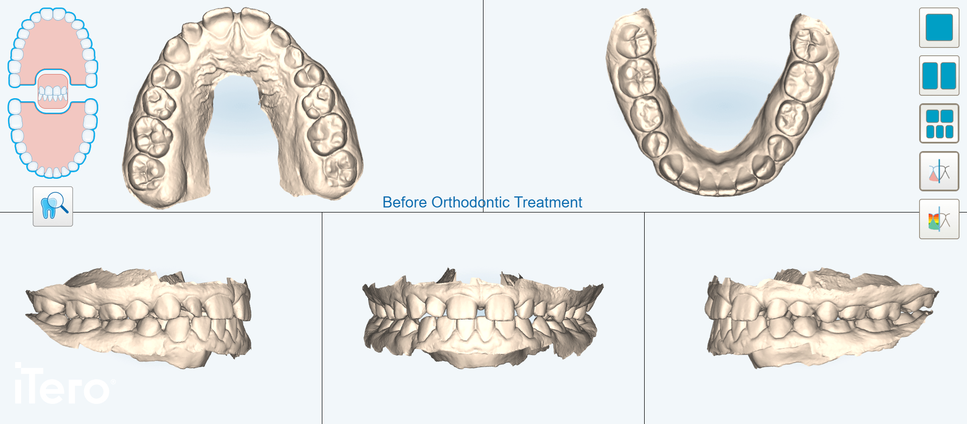 Patient-5-Invisalign-Bonding-Before-2