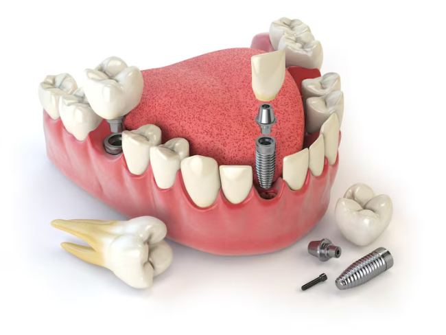 Can dental implants help with speech problems caused by missing teeth dental implants near me